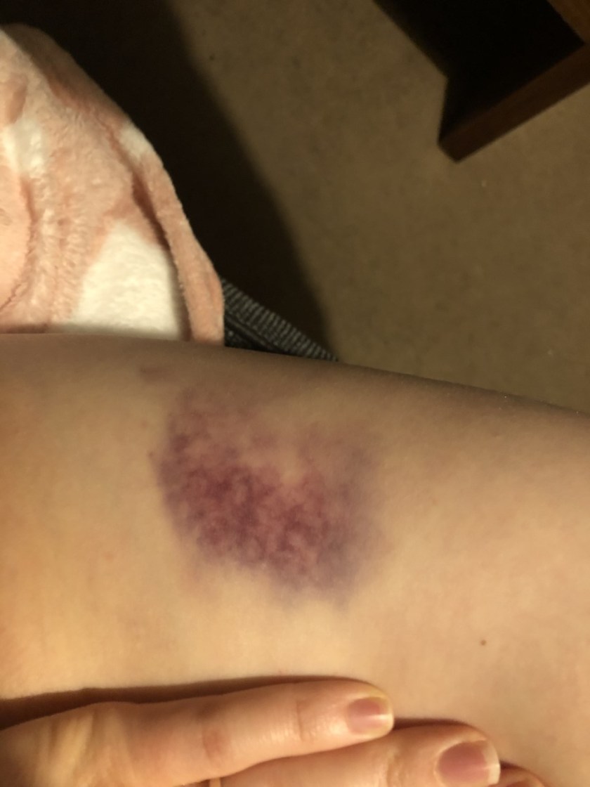 superman bruise